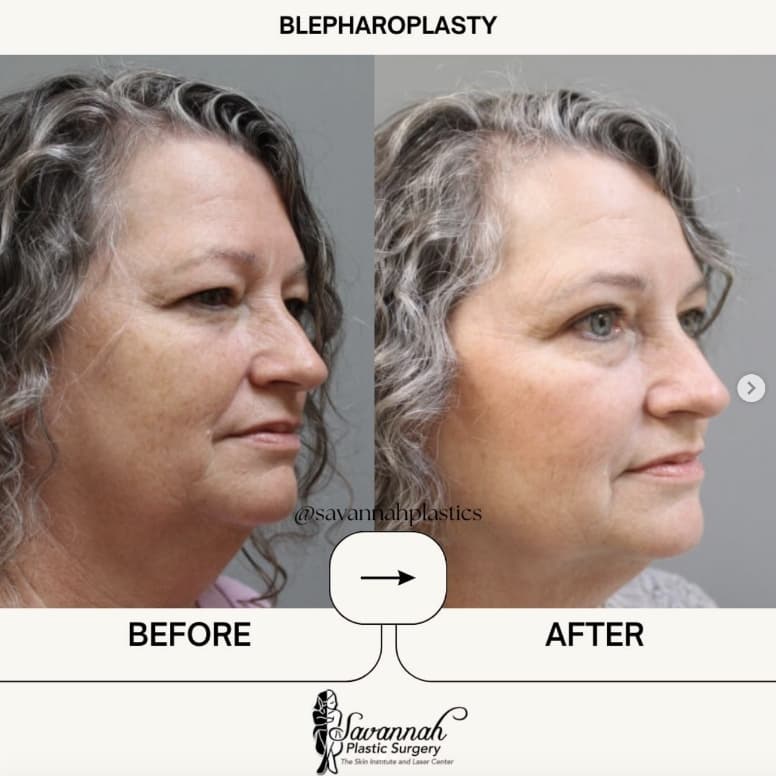 Before & After Blepharoplasty