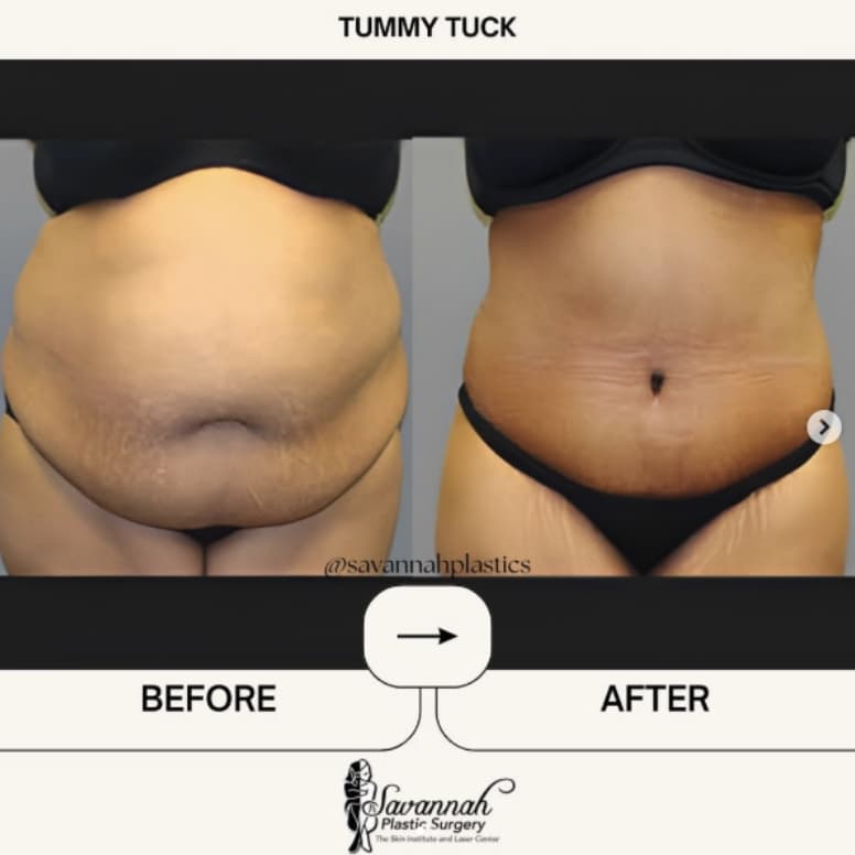 Before & After Tummy Tuck