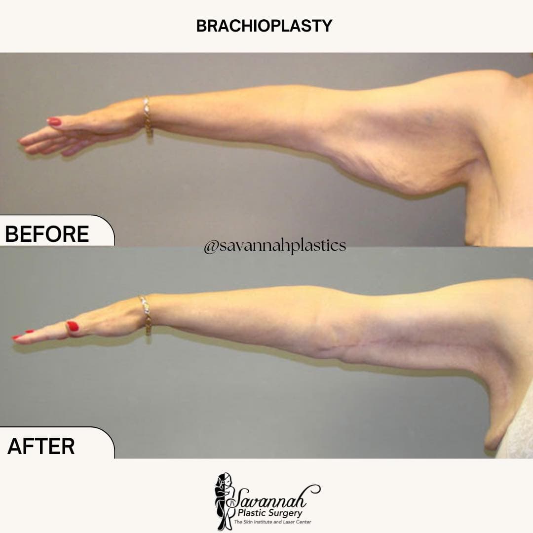 Before & After Brachioplasty
